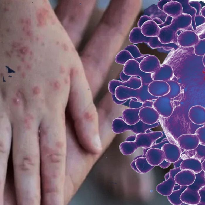 ¿Deberíamos temer a la viruela símica?